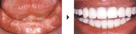 写真：インプラント